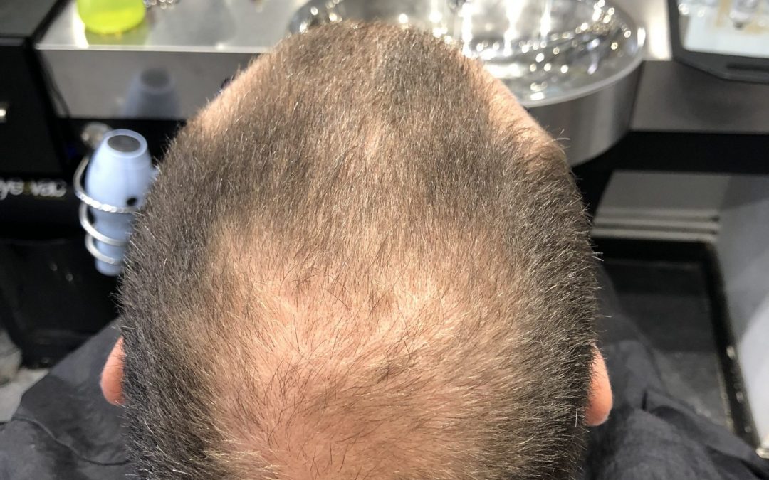 Are you suffering from thinning hair?